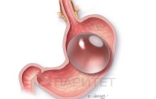 Баллонирование желудка в клинике Паритет, г. Ярославль