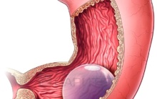 Баллонирование желудка схема