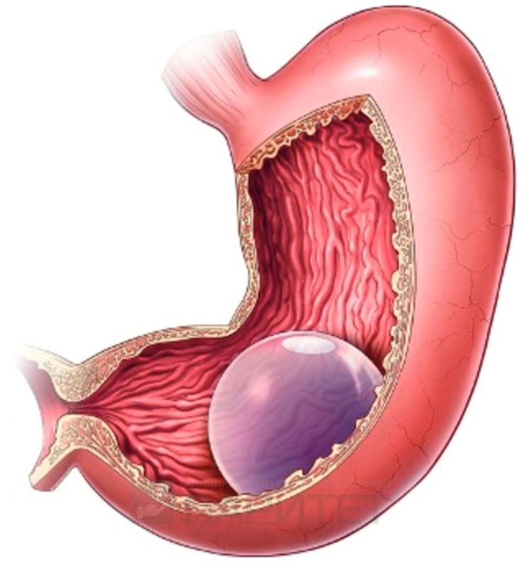 Лечение ожирения методом баллонирования желудка 