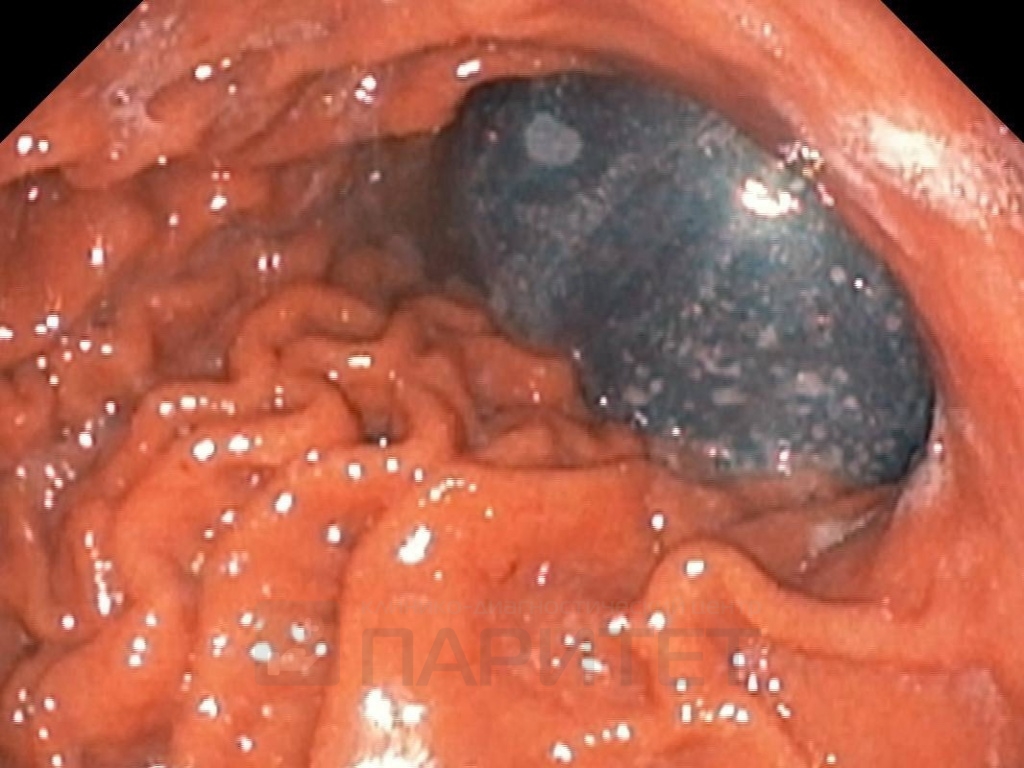Внутрижелудочное баллонирование в КДЦ Паритет Внутрижелудочное баллонирование в КДЦ Паритет